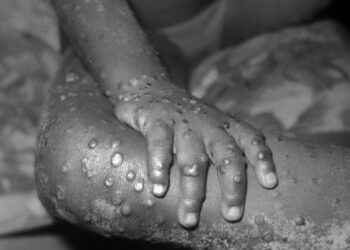 La Viruela del Mono produce erupción de la piel en varias partes del cuerpo, aparecen llenas de líquido transparente o amarillento.