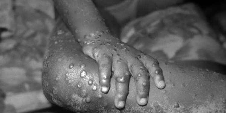 La Viruela del Mono produce erupción de la piel en varias partes del cuerpo, aparecen llenas de líquido transparente o amarillento.