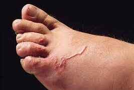 En Estados Unidos, a principios del siglo XX, se relacionó esta dermatosis con la miasis. Cincuenta años después, Kirby-Smith descubrió la larva de un nemátodo en una biopsia de piel cuando realizaba infecciones experimentales en humanos con larvas de Ancylostomas caninos y felinos para contraer la enfermedad. La revista de Dermatología Peruana describe que la larva migrante cutánea es una dermatosis aguda producida por Ancylostoma caninum y A. brazilense de perro y gato. El parásito adulto habita en el intestino delgado de estos animales, donde produce huevos que salen con las materias fecales. En suelos preferentemente arenosos, caliente y húmedo es donde los huevos embrionan y dan lugar a las larvas infectantes. Las zonas más afectadas son las áreas descubiertas y que contactan con el suelo: pies, mano, espalda, nalgas, muslos. Si el progreso de la enfermedad no se interrumpe con tratamiento, estas lesiones se extienden seis meses. Alicia Fernández, habitante de Sucumbíos, dio testimonio que a su hija se le metió en sus pies una larva llamada Migrans. El diagnóstico médico fue que esta larva está en las heces de los perros y gatos y que se contrae al caminar descalzos. Las recomendaciones del Centro de Control y Prevención de enfermedades (CDC) de Estados Unidos son: - Mantener a los perros y gatos bajo el control veterinario, centrado en la desparasitación. - Lavado de manos luego del contacto con perros y gatos, especialmente antes de comer. -No permitir que los niños jueguen en áreas donde los animales han defecado. -Recoger y eliminar apropiadamente las deposiciones de los animales. - Mantener limpia el área donde viven los perros y gatos. - Evitar que los niños coman tierra o introduzcan objetos sucios a la boca.