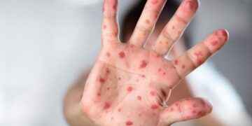 El MSP insta a mantener la calma pese a que semana a semana crecen los contagios.