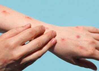 La OMS declara a la viruela del mono como nueva emergencia de salud pública internacional.