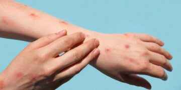 La OMS declara a la viruela del mono como nueva emergencia de salud pública internacional.