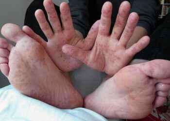 Aumentan en Ecuador los casos de la enfermedad de manos, pies y boca en niños menores de cinco años