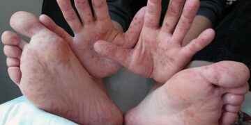 Aumentan en Ecuador los casos de la enfermedad de manos, pies y boca en niños menores de cinco años