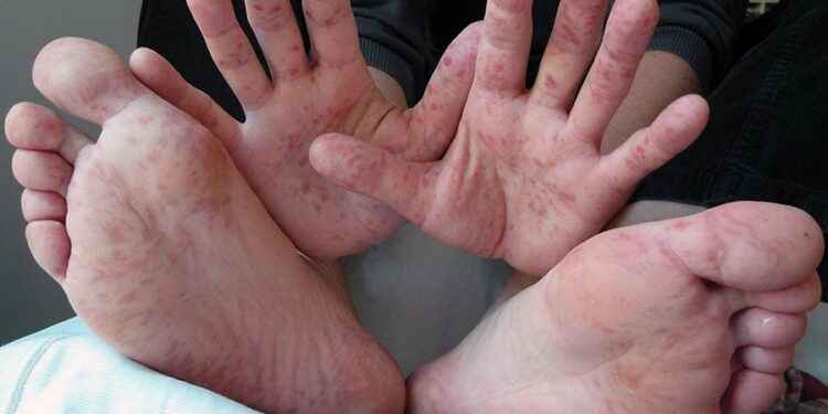 Aumentan en Ecuador los casos de la enfermedad de manos, pies y boca en niños menores de cinco años